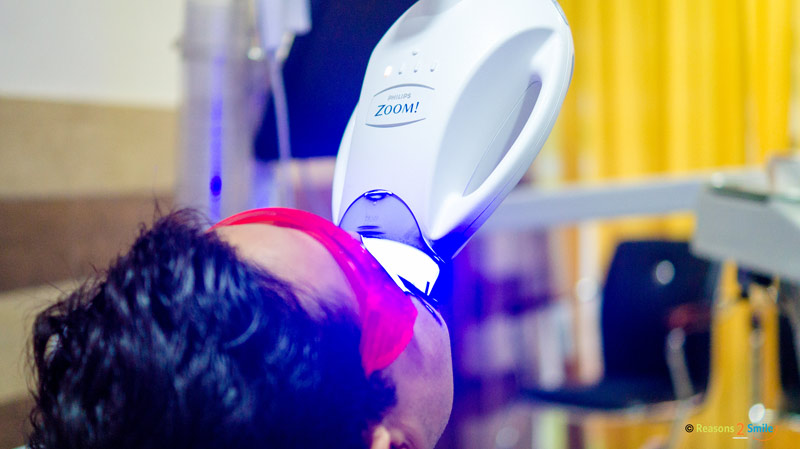 Zoom Teeth Whitening in Patna Bihar